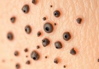 Zaskórniki – przyczyny, pielęgnacja i skuteczne metody walki Zaskórniki – przyczyny, pielęgnacja i skuteczne metody walki