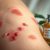 Alergia skórna – objawy, leczenie i skuteczna pielęgnacja