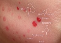 Badania na trądzik hormonalny: Jakie hormony zbadać?