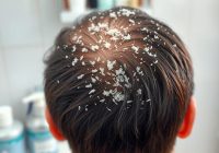 Łupież – przyczyny, objawy i sposoby leczenia tego schorzenia