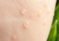 Kwas salicylowy na zaskórniki – jak skutecznie działa?