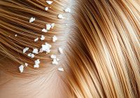 Jak leczyć łupież? Przyczyny, objawy i skuteczne metody Jak leczyć łupież? Przyczyny, objawy i skuteczne metody