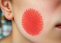 Histamina a rumień: co pogarsza problem i jak dobrać pielęgnację